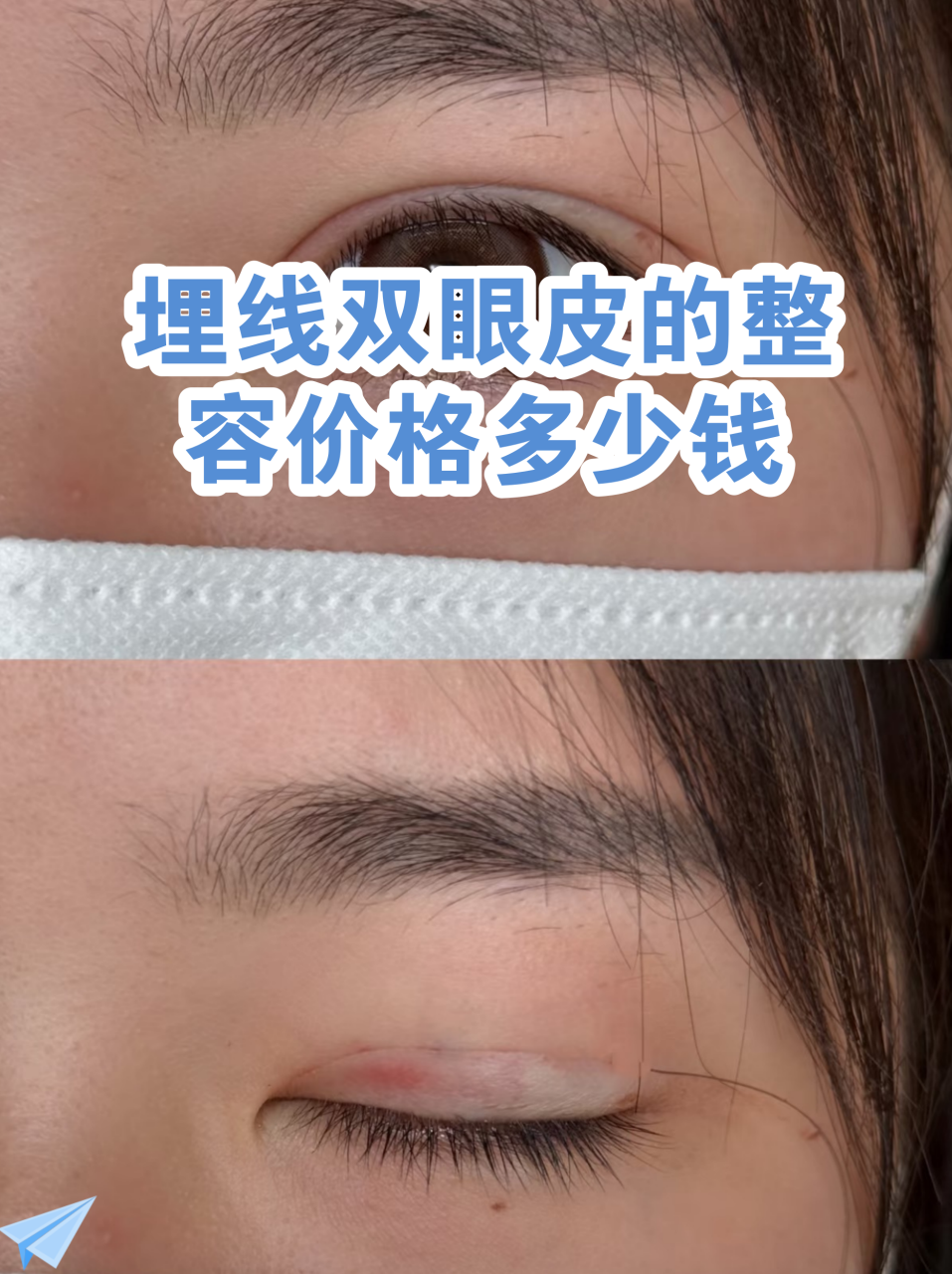 杭州做埋线双眼皮价格多少钱?如何选择靠谱的医院插图 杭州做埋线双眼皮价格多少钱?如何选择靠谱的医院插图