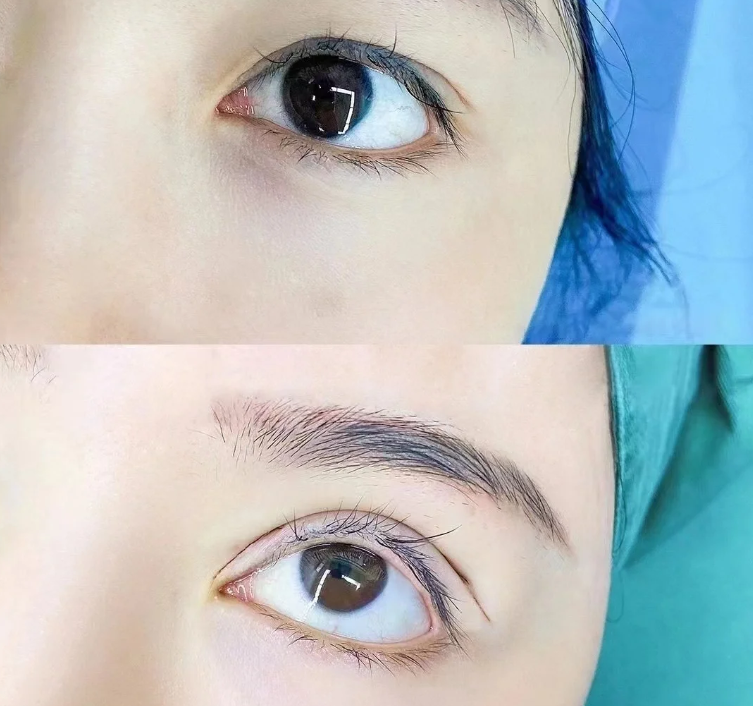 哪些人适合做吸雕双眼皮?术后有哪些注意事项?插图 哪些人适合做吸雕双眼皮?术后有哪些注意事项?插图