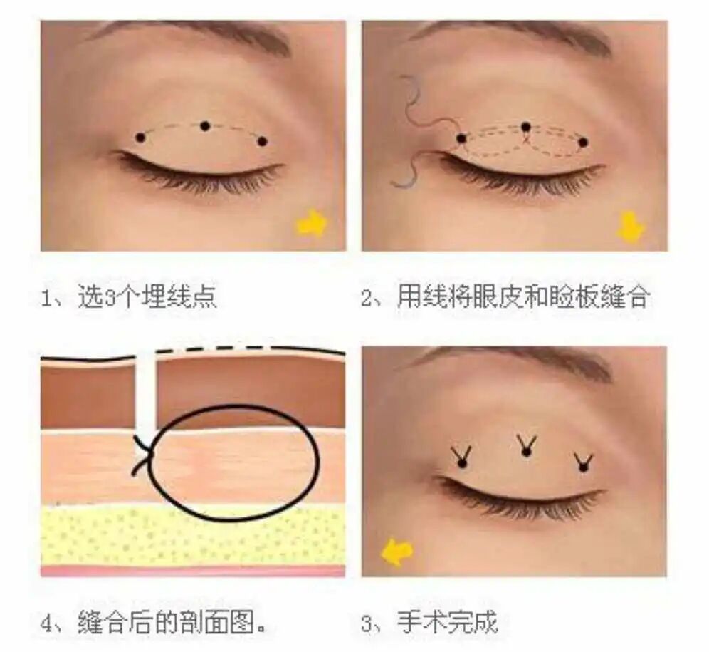 埋线双眼皮的主要优势有哪些？埋线双眼皮会不会有后遗症？