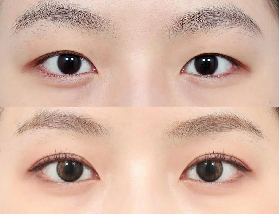 做双眼皮可以解决大小眼问题吗？大小眼该怎么做？