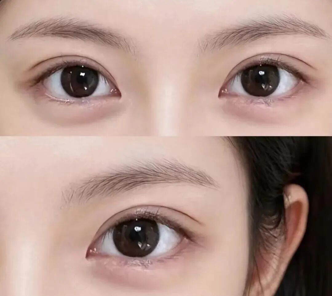 埋线双眼皮能直接改全切吗？全切双眼皮适应人群有哪些?