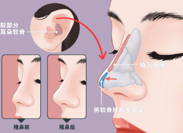 耳软骨隆鼻后多久恢复?耳软骨隆鼻是什么?插图 耳软骨隆鼻后多久恢复?耳软骨隆鼻是什么?插图
