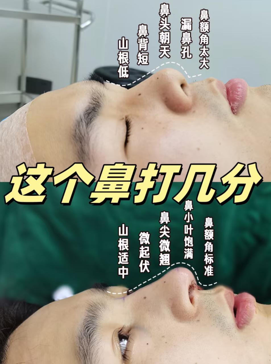 南京华韩奇致美容医院贺小虎医生做隆鼻怎么样?插图1 南京华韩奇致美容医院贺小虎医生做隆鼻怎么样?插图1