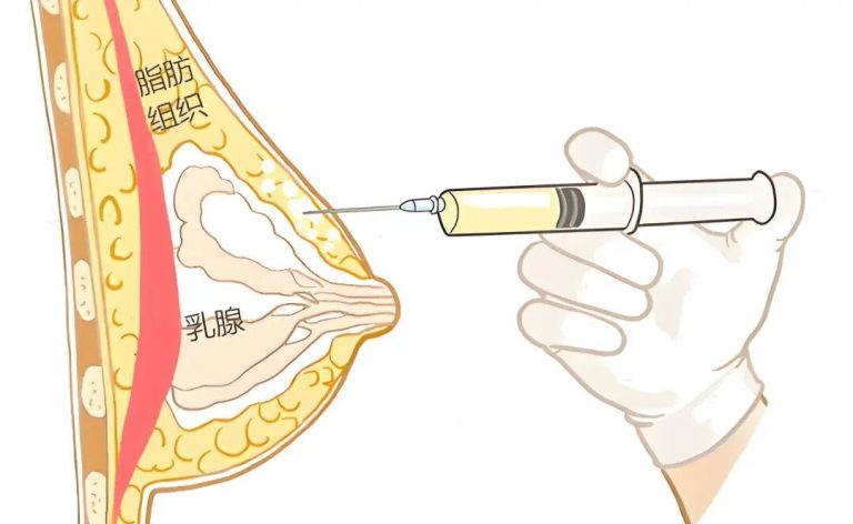 自体隆胸需要多少脂肪?插图 自体隆胸需要多少脂肪?插图
