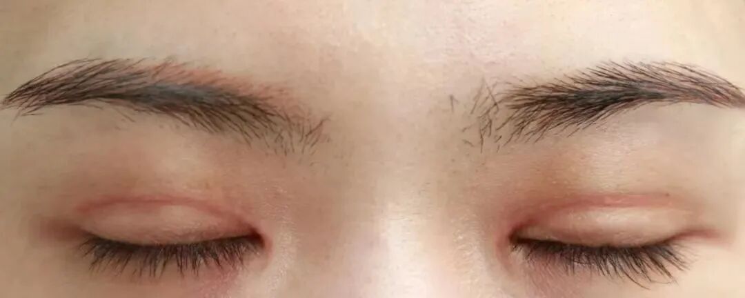 割双眼皮术后会留疤痕吗？插图