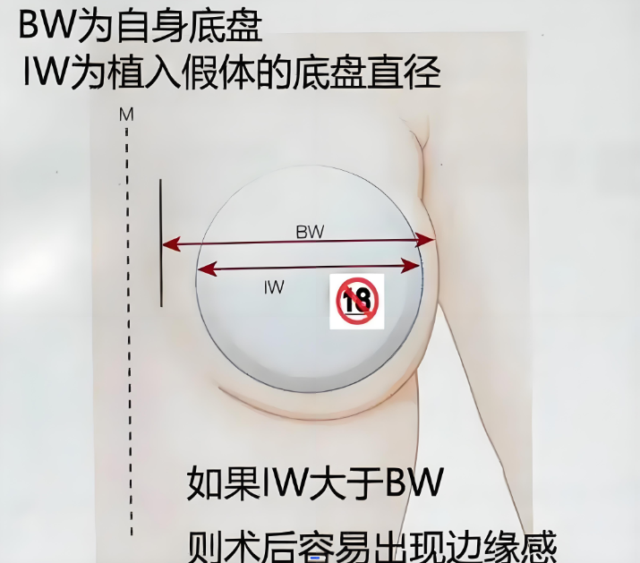 隆胸假体的大小怎么选择？隆胸手术需要全裸吗？