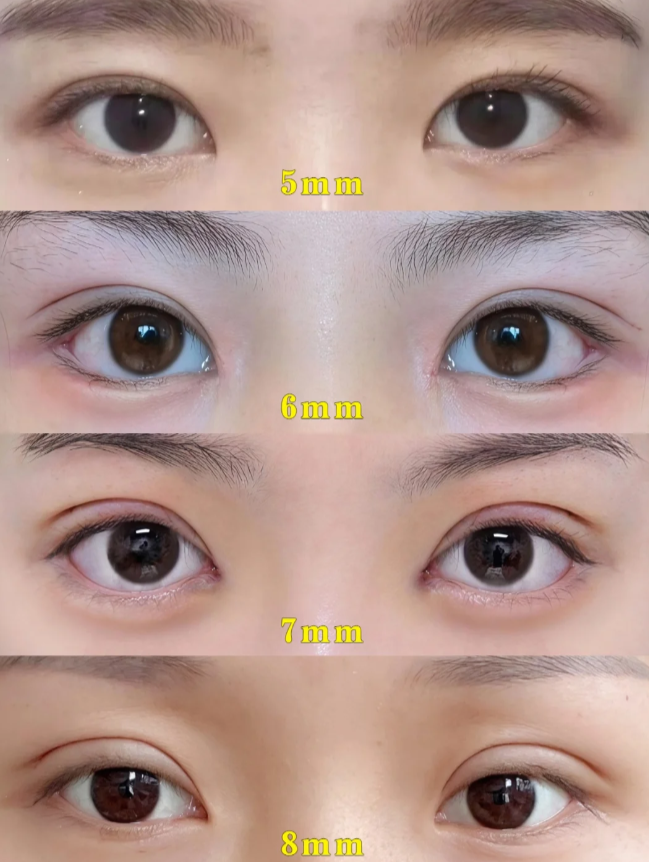 双眼皮割多宽才好看?插图 双眼皮割多宽才好看?插图