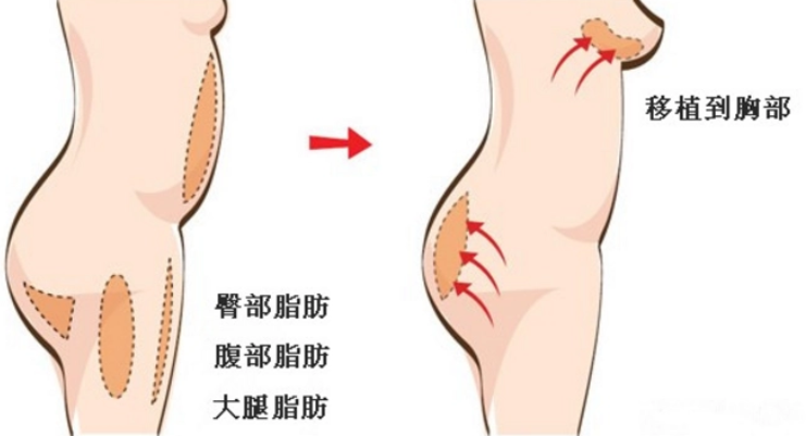 什么是自体脂肪隆胸？自体脂肪隆胸要多少脂肪？插图