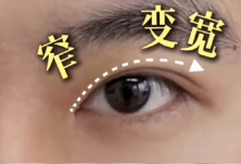 男士割双眼皮效果？插图