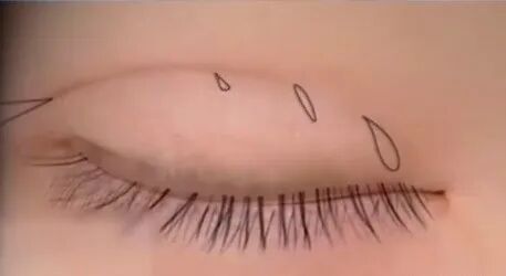 水肿眼睛做什么双眼皮插图