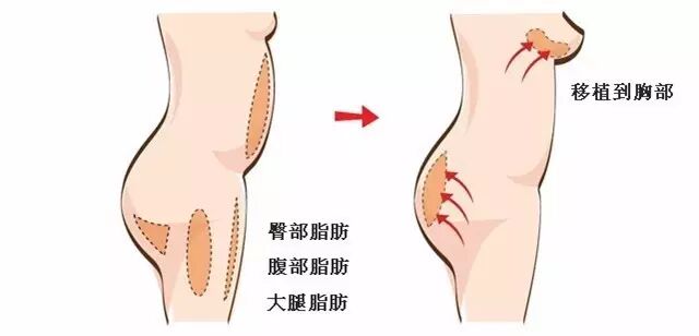 自体脂肪隆胸效果怎么样？自体脂肪隆胸可以保持多少年？