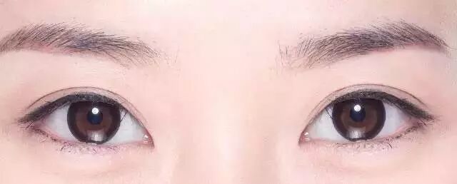 欧式双眼皮和三点双眼皮哪个更符合大众审美？插图1