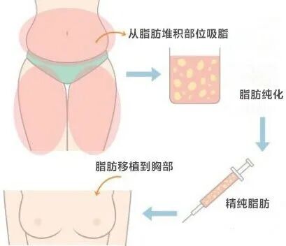 自体脂肪隆胸是用哪个部位的脂肪?自体脂肪隆胸需要具备什么条件?插图 自体脂肪隆胸是用哪个部位的脂肪?自体脂肪隆胸需要具备什么条件?插图