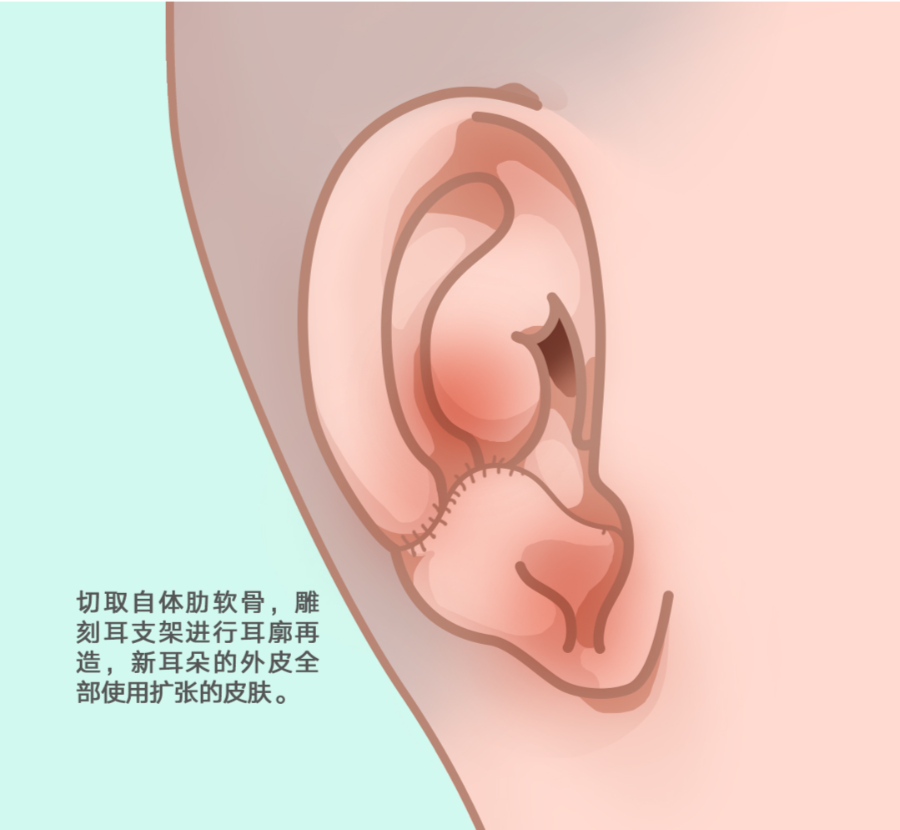 成都西区医院王韶亮医生全耳廓再造技术怎么样?插图 成都西区医院王韶亮医生全耳廓再造技术怎么样?插图
