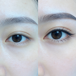 如何选择专业可靠的拉双眼皮整形医院？