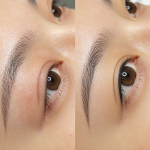 眼皮下垂怎么改善?