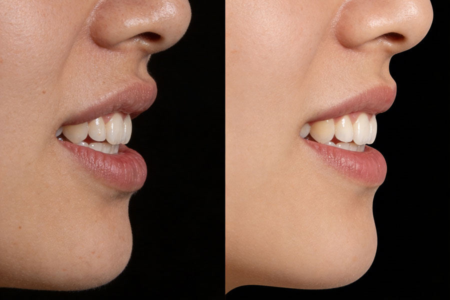 上下颚手术/突嘴矫正