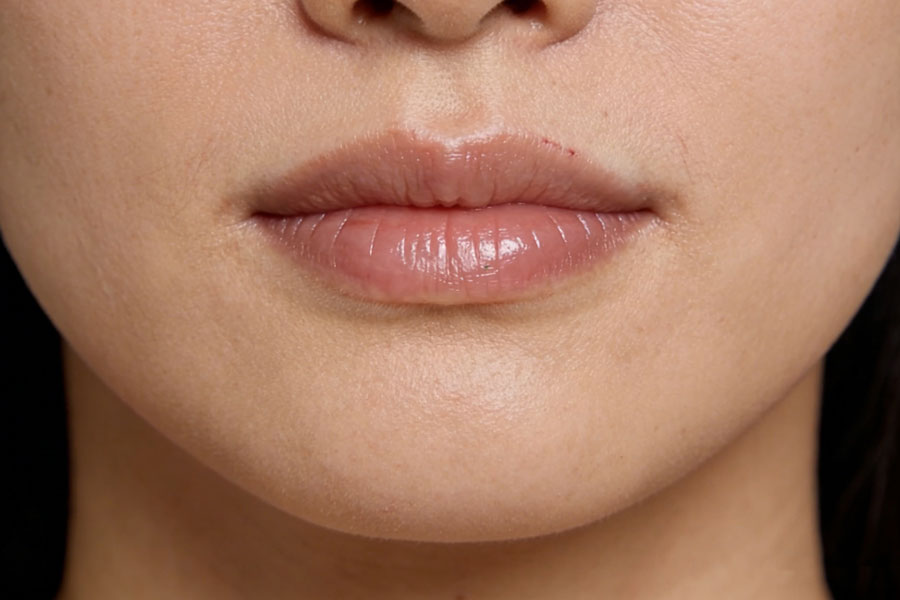 下巴硅胶假体取出