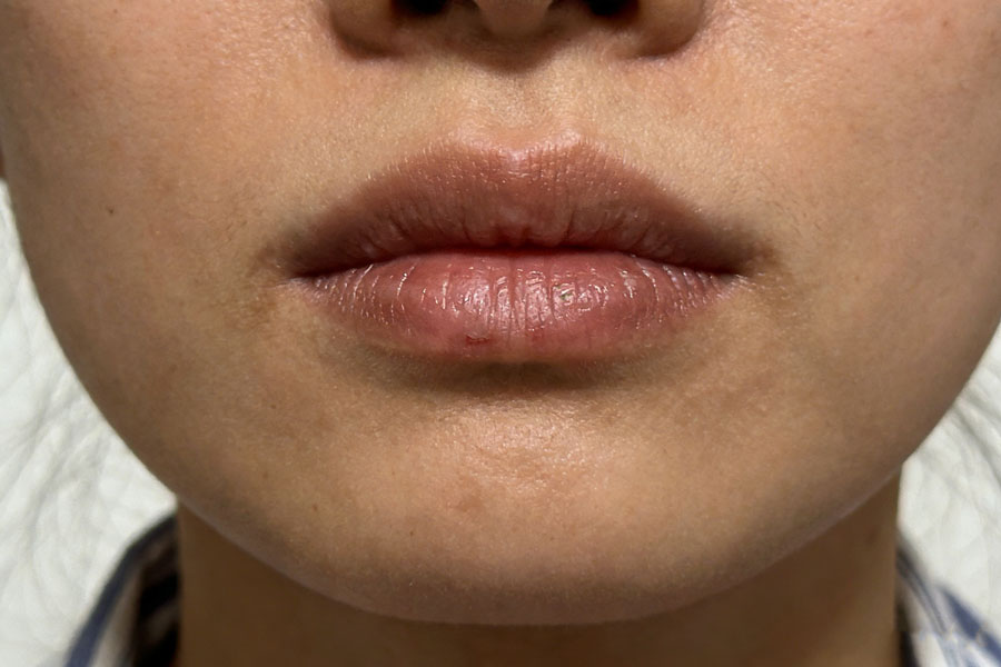 下巴膨体假体取出