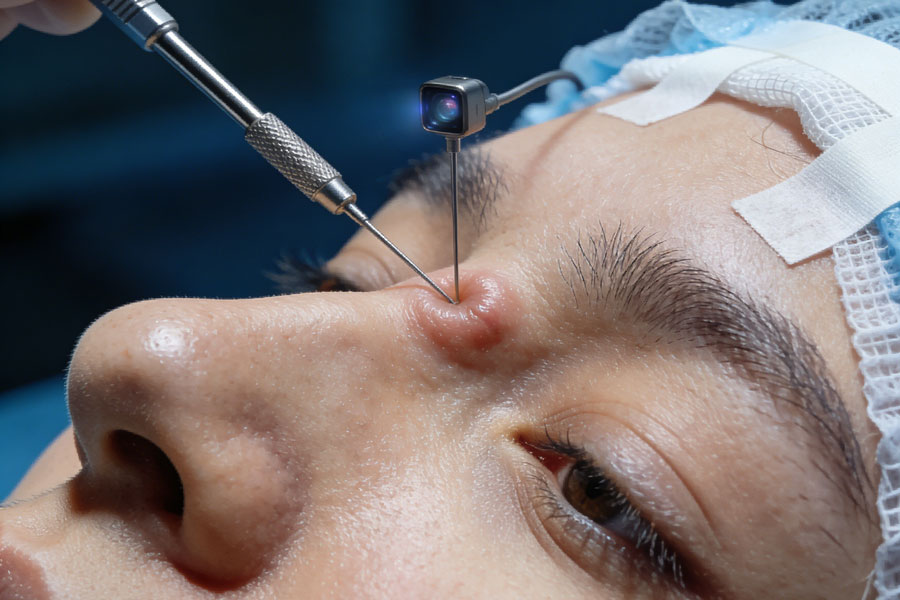 内窥镜手术提升