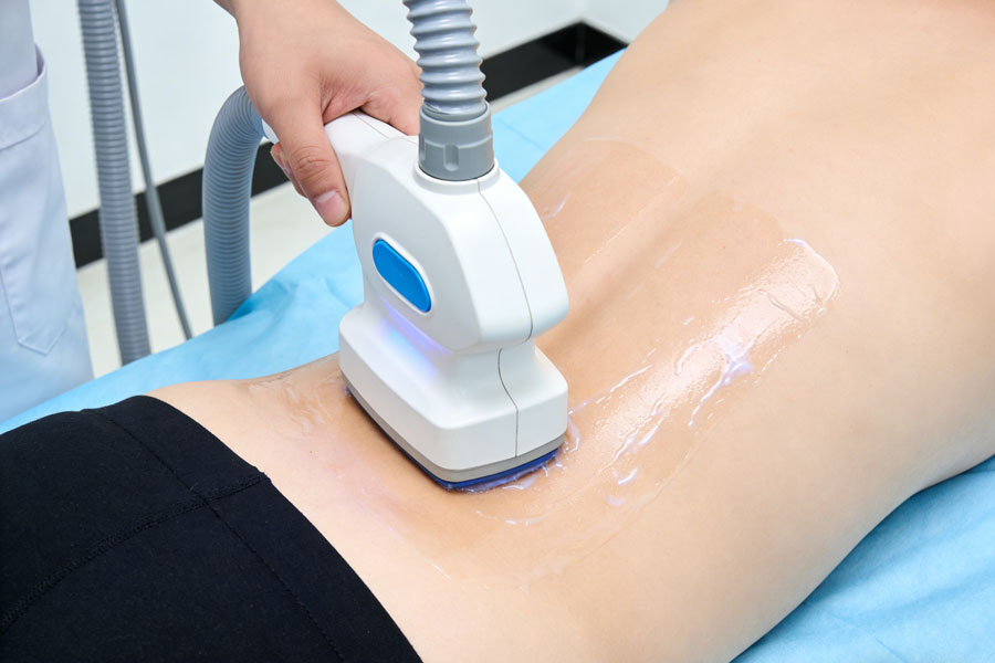 冷冻溶脂瘦背部