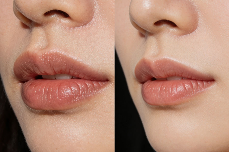 厚唇改薄