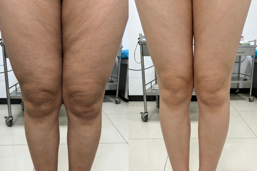 吸脂瘦大腿
