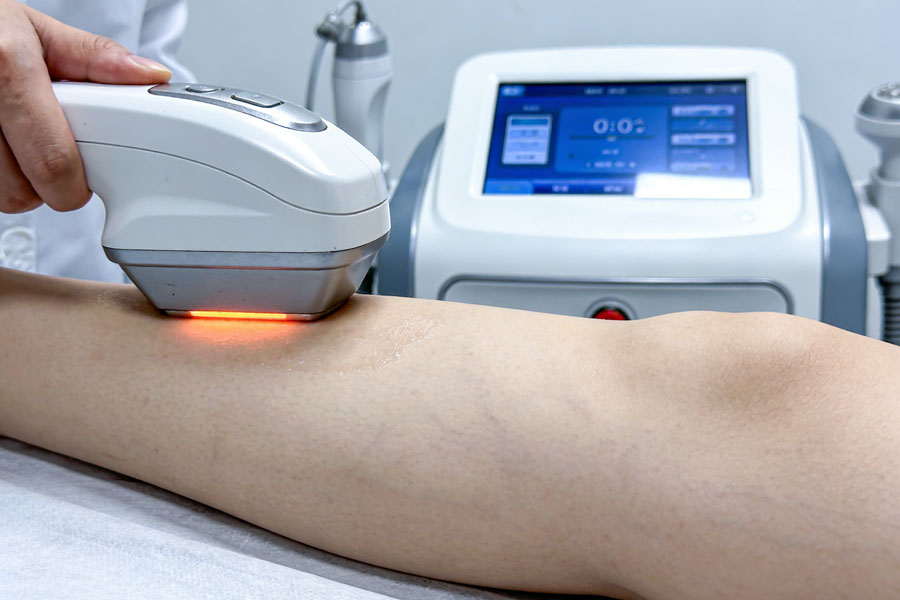 射频溶脂瘦小腿