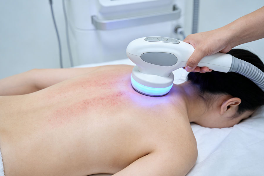 射频溶脂瘦背部