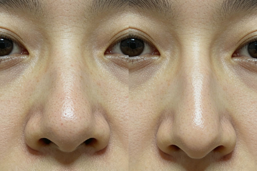 手术延长鼻小柱