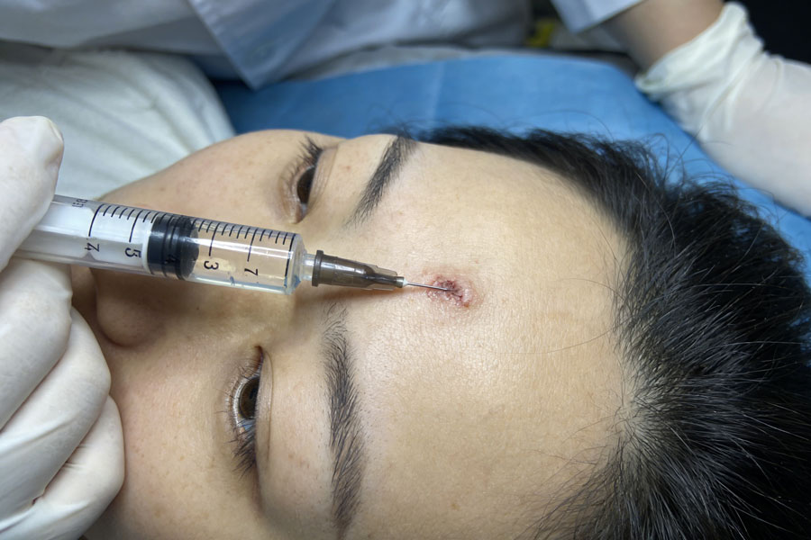 注射祛疤