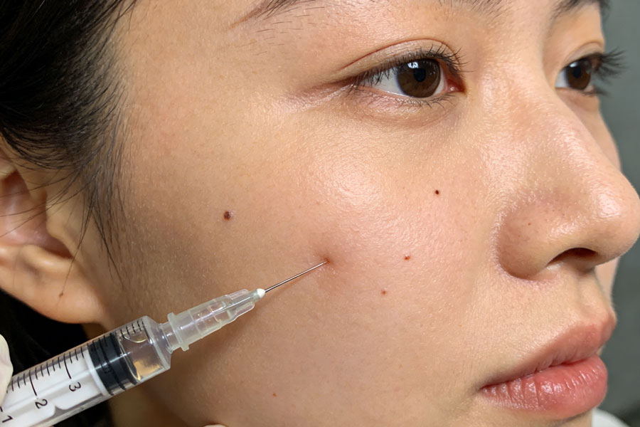 玻尿酸丰苹果肌