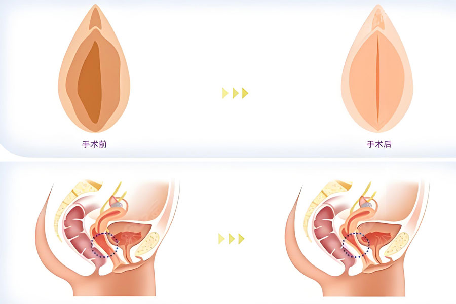 手术紧缩阴道