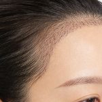 发际线过高怎么办？发际线怎么调整效果好？