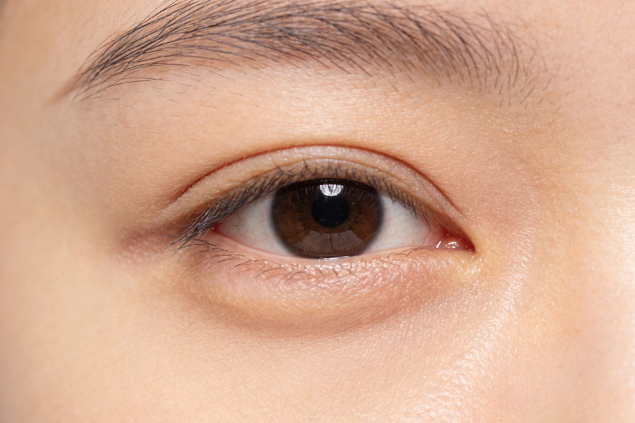 自体脂肪丰卧蚕