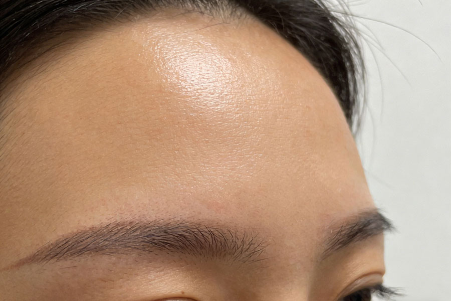 自体脂肪丰额头