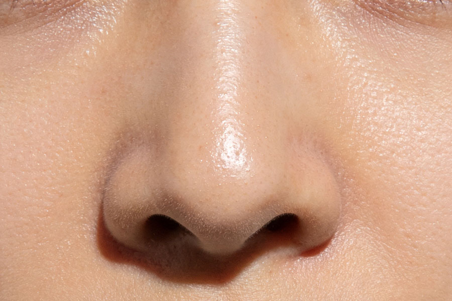 自体脂肪丰鼻基底