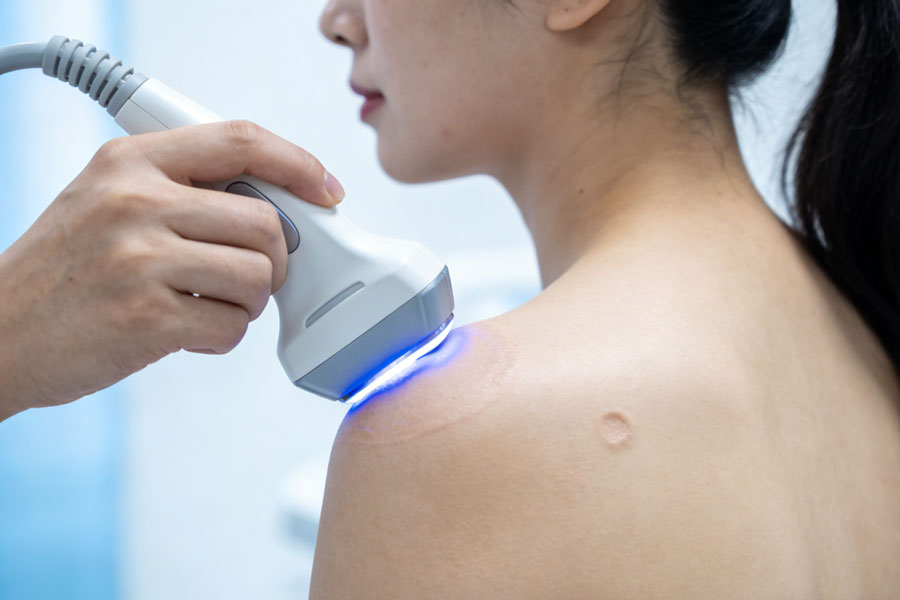 超声溶脂瘦肩部