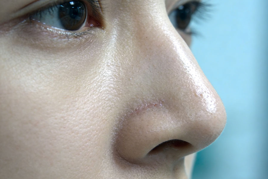 鼻中隔软骨隆鼻