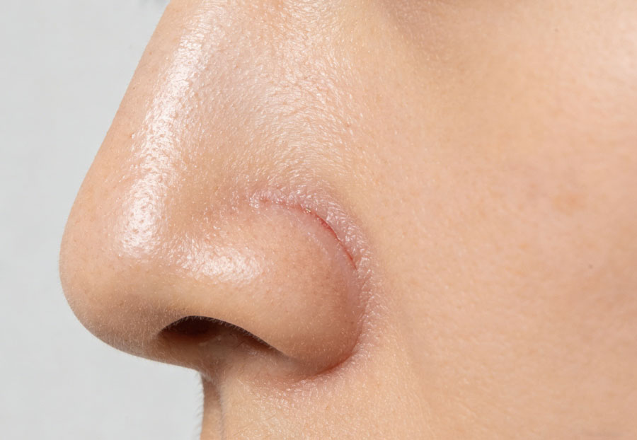 鼻部硅胶假体取出