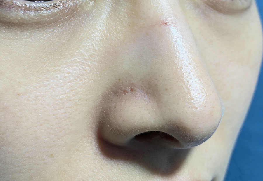 鼻部膨体假体取出