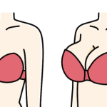 孙家明医生隆胸技术分析：切口选择、植入层次、术后形态一文读懂