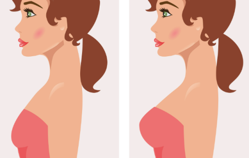 吴毅平隆胸手术怎么样？形态、手感、疤痕情况系统梳理