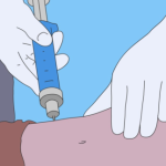 宋新吸脂怎么样？反弹吗？技术特点、风险点和术后护理要点