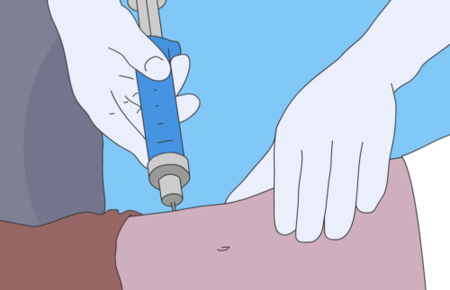 宋新吸脂怎么样？反弹吗？技术特点、风险点和术后护理要点