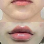 玻尿酸丰唇效果怎么样？玻尿酸丰唇效果可以持续多久