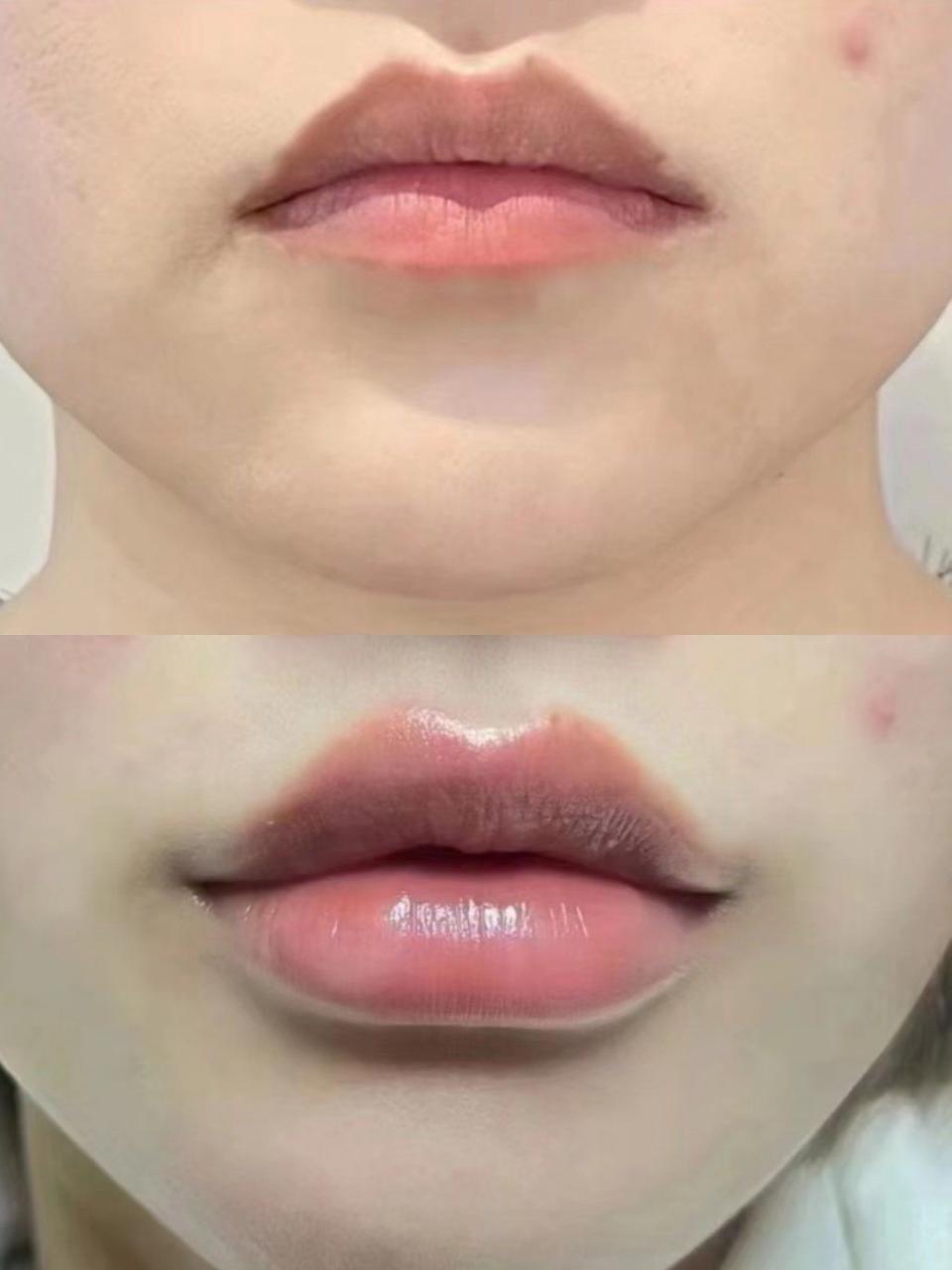 玻尿酸丰唇效果怎么样？玻尿酸丰唇效果可以持续多久