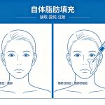 北京整形医院自体脂肪填充有哪些优势？