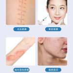 长沙哪个医院祛疤最好?本地人推荐这几家