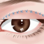 刘珍君做双眼皮怎么样？恢复快不快、线条自然不自然一篇看懂